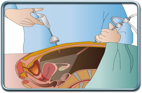 ניתוח בגישה לפרוסקופית- Laparoscopic surgery