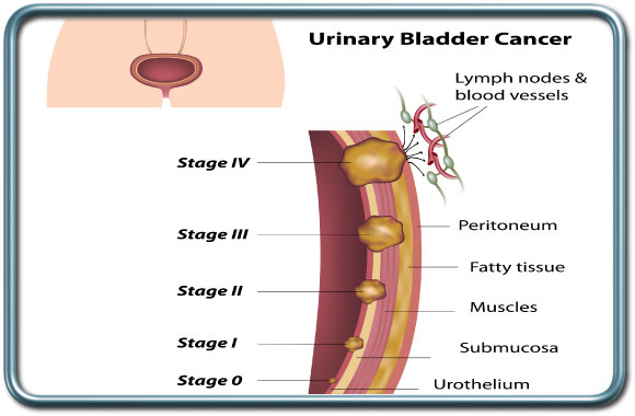 שלבי סרטן השלפוחית- Urinary Bladder cancer stages
