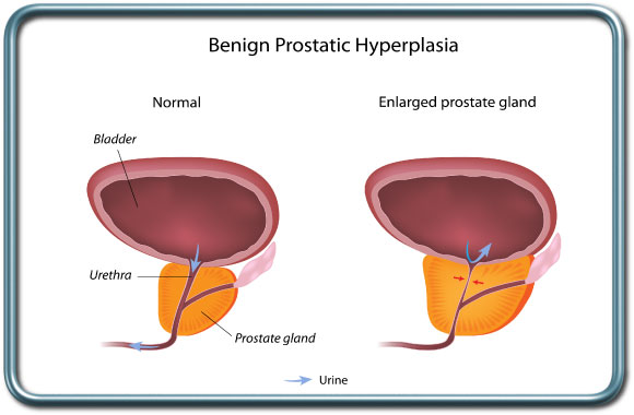 הגדלה שפירה של בלוטת הערמונית- Benign prostatic hypertrophy (BPH)
