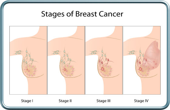 שלבי סרטן השד- Breast cancer stages
