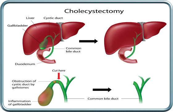 כריתת כיס המרה- Cholecystectomy
