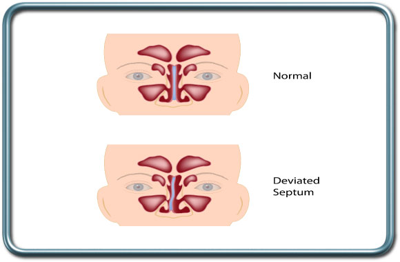 סטיית מחיצת האף- Deviated nasal septum (DNS)
