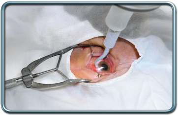 ניתוחי עיניים- Eye surgery