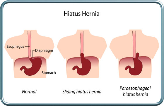 בקע סרעפתי- Hiatal hernia