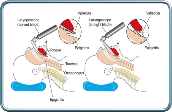 לרינגוסקופיה ישירה- Direct laryngoscopy