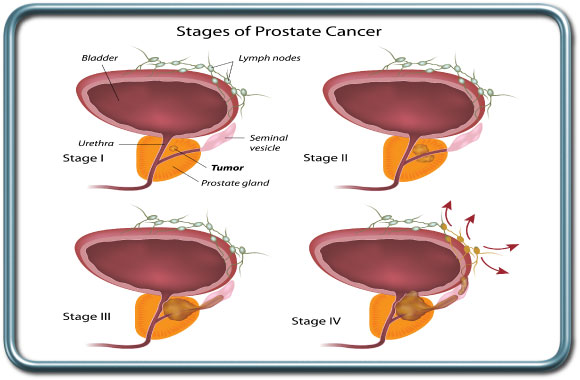 שלבי סרטן הערמונית- Prostate Cancer staging
