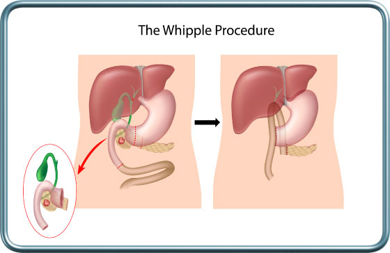 פרוצדורה על שם וויפל- Whipple procedure